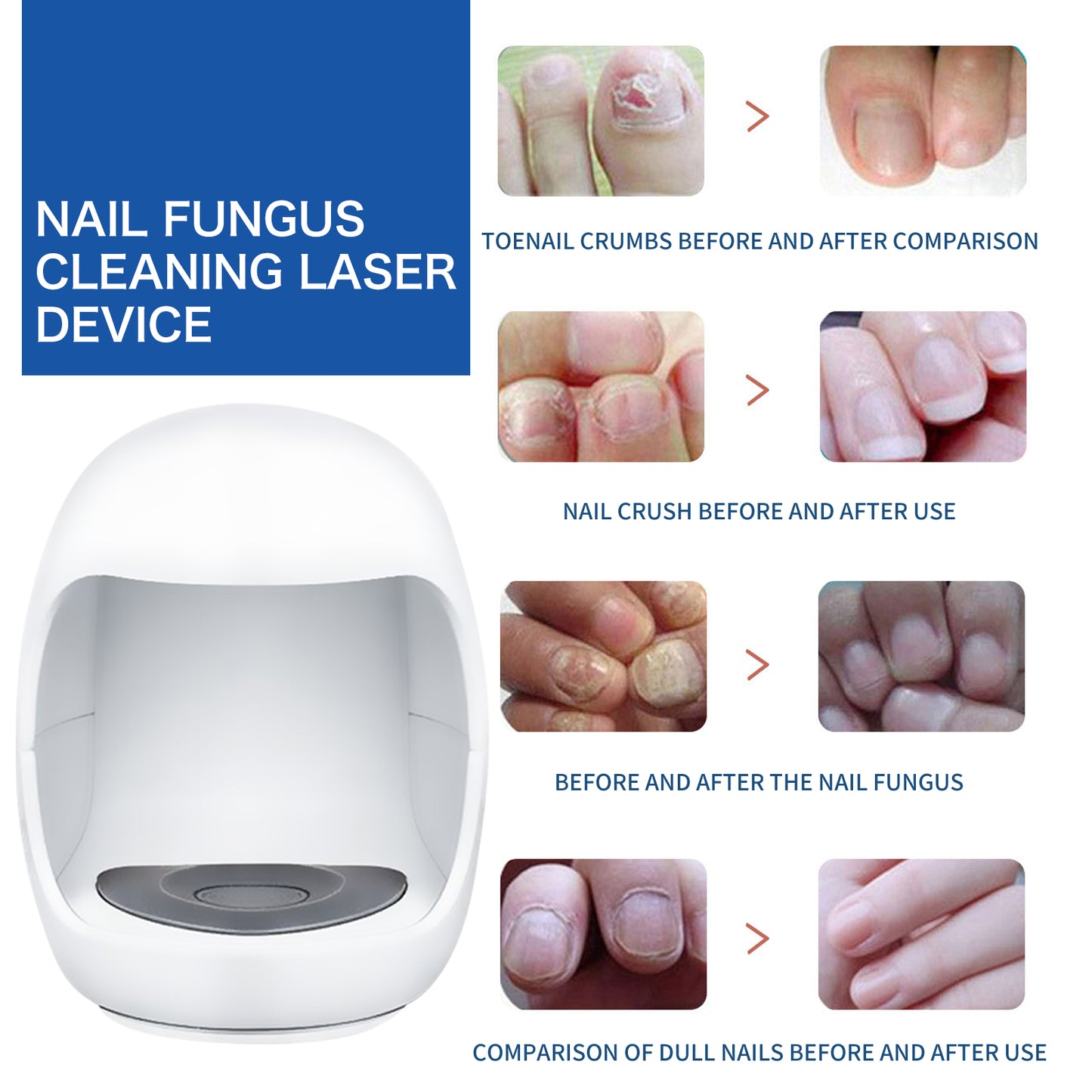 Appareil de Photothérapie pour Soins des Ongles South Moon – Réparation Ongles Gris, Jaunes, Incarnés